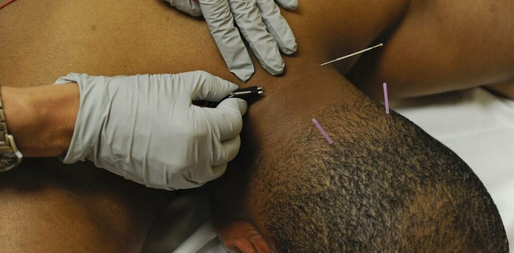 black american patient receiving myofascial trigger point dry needling