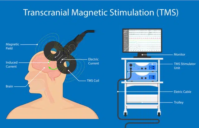 Medical illustration of Transcranial Magnetic Stimulation (TMS) procedure