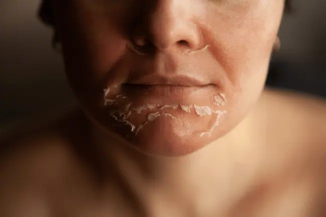 Image of woman skin after doing chemical peeling.