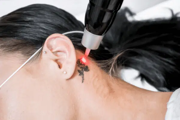 Woman under going Picocare 450 laser tattoo removal procedure at the back of her ear.