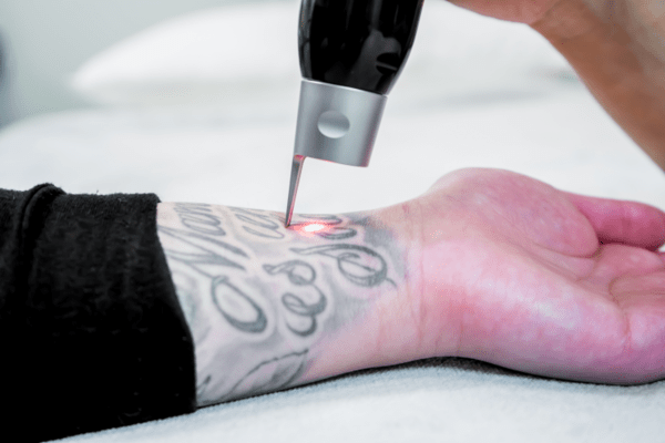 Man under going tattoo removal procedure on his hands.