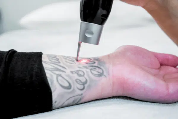 Man under going tattoo removal procedure on his hands.