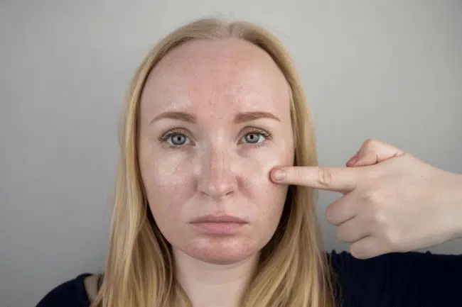 Image of woman having Skin Pigmentation.