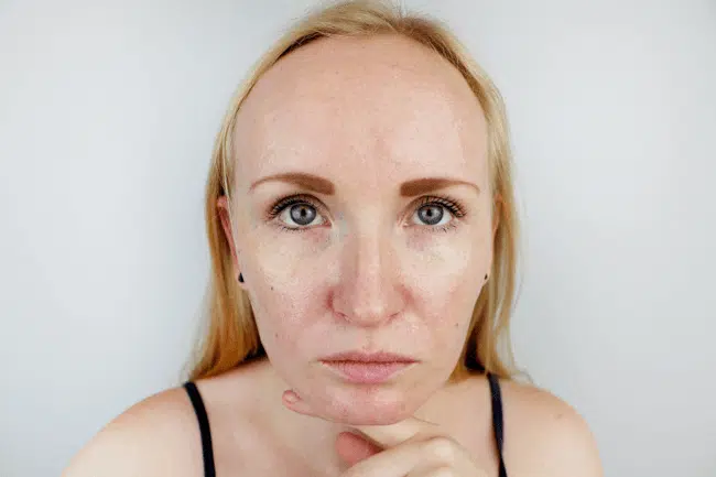 Image of woman having Skin Pigmentation.