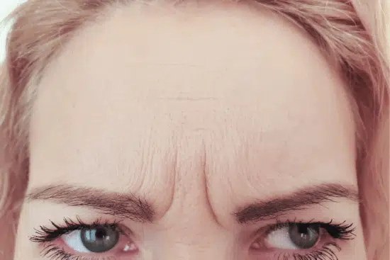 Woman having fine lines and wrinkles on her eyebrows.