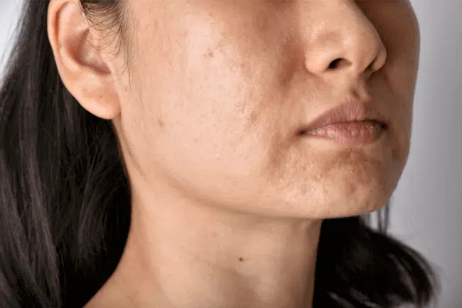 Face of woman with skin problem and acne scars.