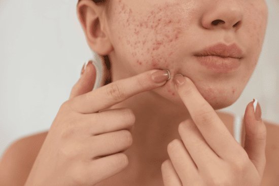 Woman with face problems and acne scars picking her pimples.