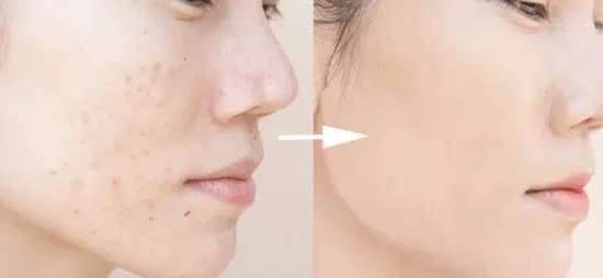 Image of a woman before and after doing some acne scars.