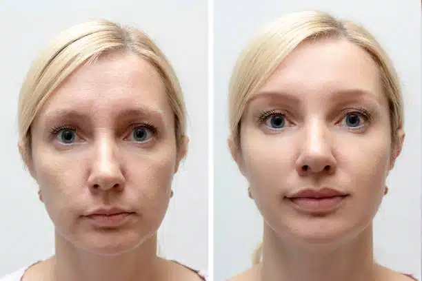 Woman face with wrinkles and age change before and after Skin Revitalization procedure.