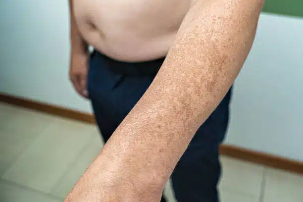 Middle aged man having sun spots damaged on his skin caused by too much sun exposure.