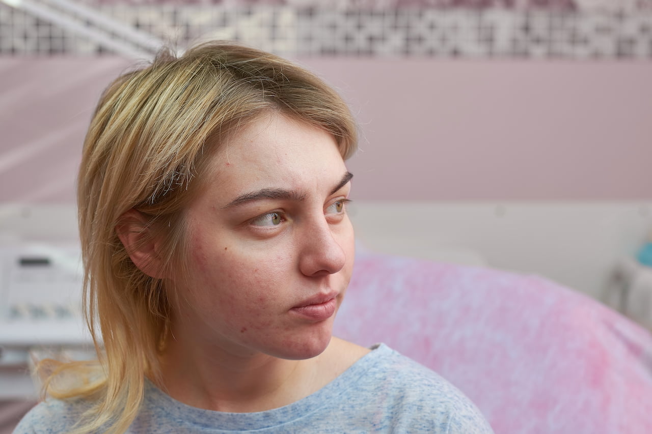 Woman with Acne scars on her face.