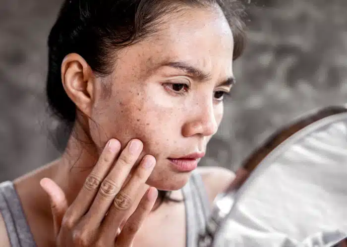 Close up image of a woman having a melasma spots on her face.