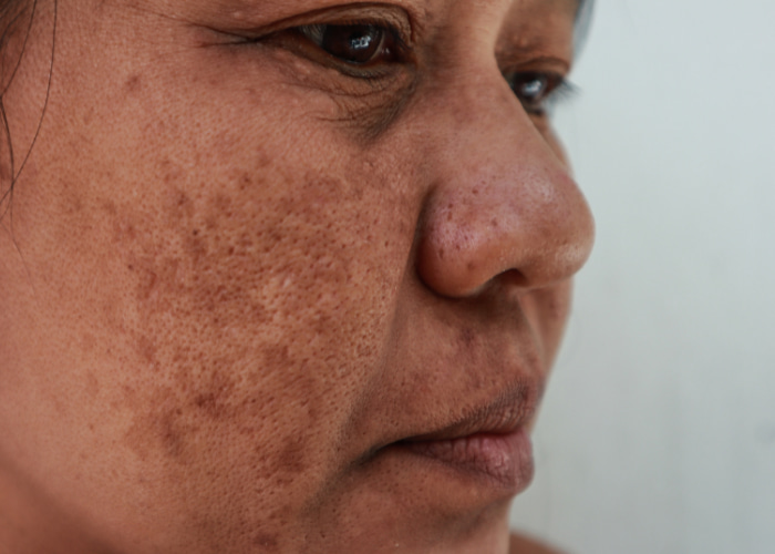 Close up image of a woman having a melasma spots on her face.